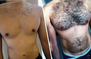 mens laser hair removal